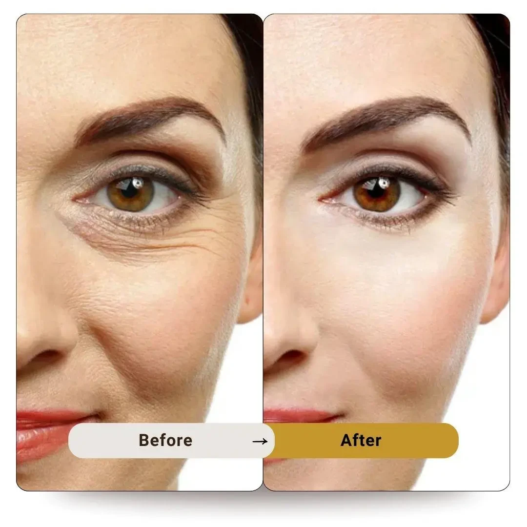 Full Face Botox Dubai | Botox Treatment Elite Body Home