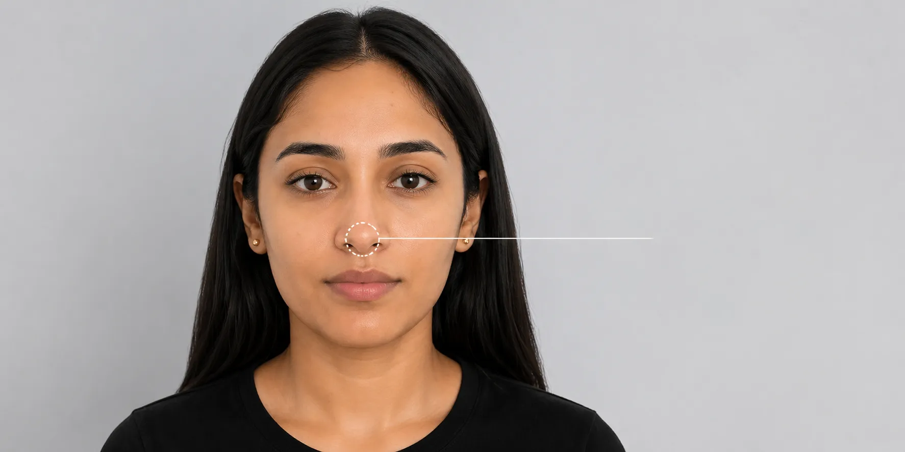 Nasal Tip (Tip Lift Area)