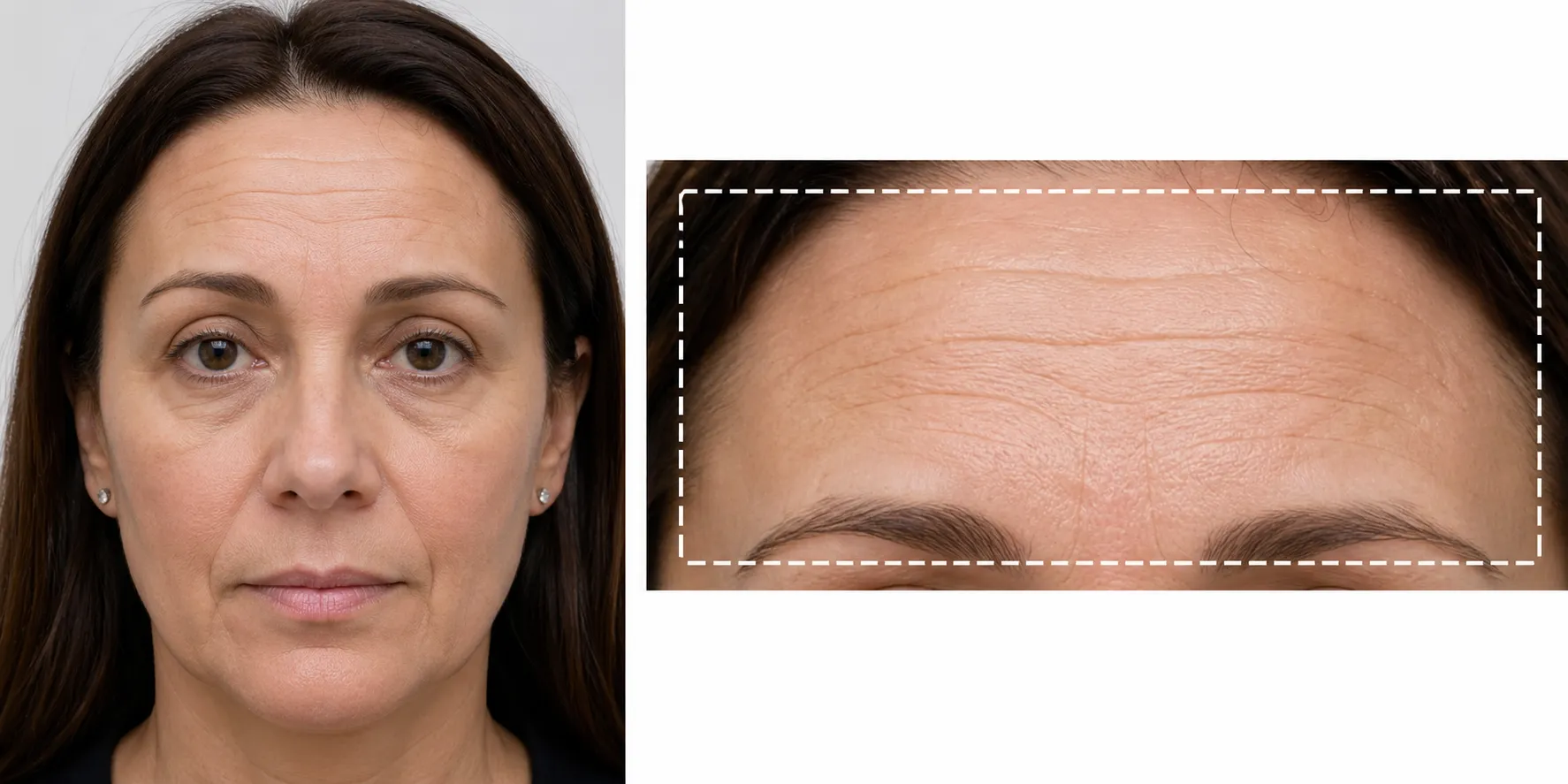 wrinkle-reduction-Forehead-Lines