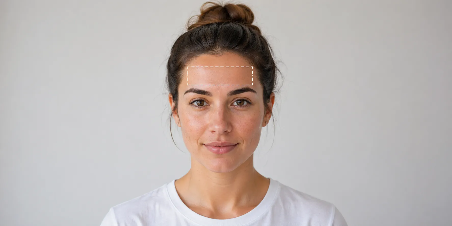 scar-removal-Forehead