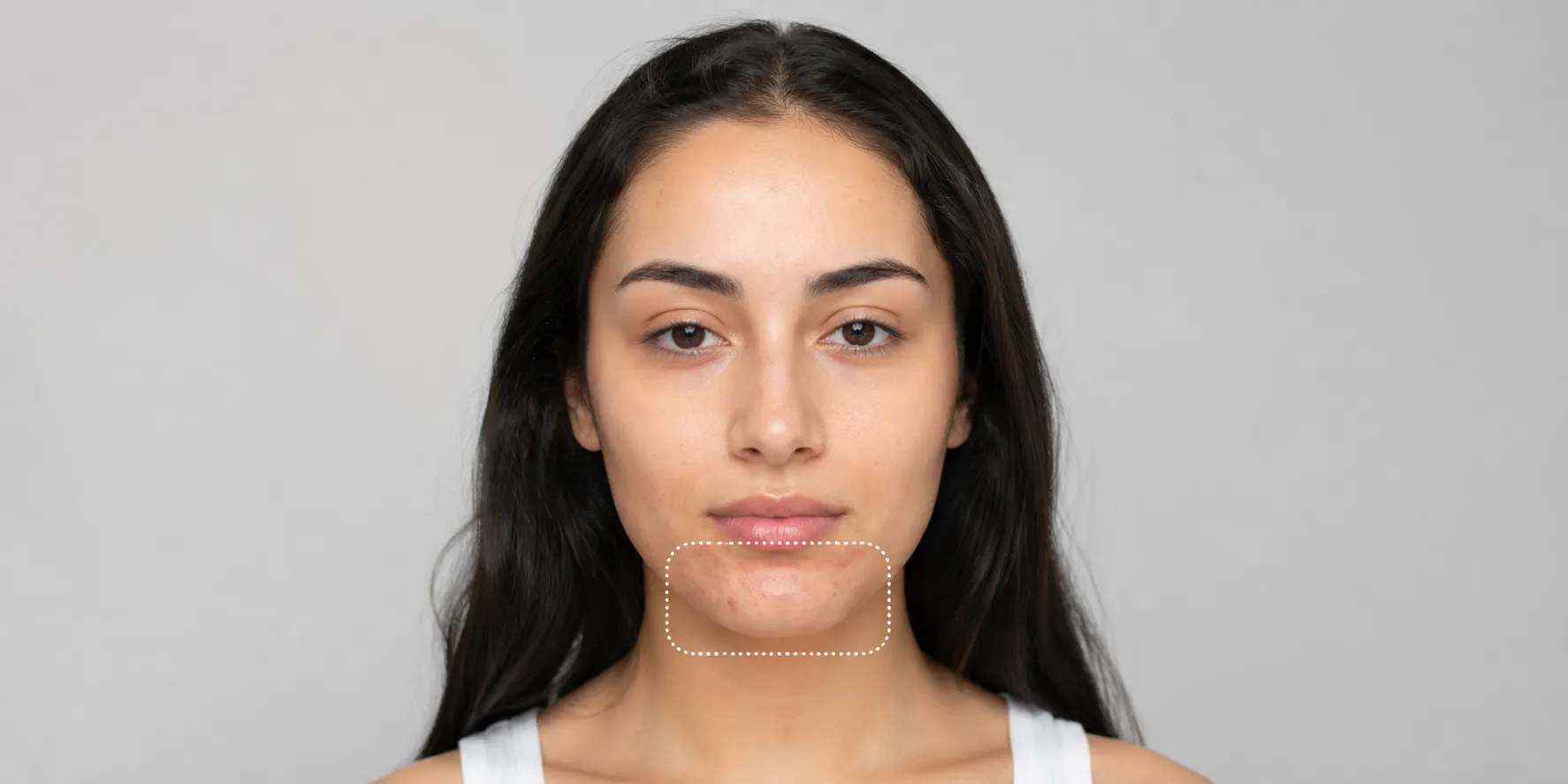 scar-removal-Chin