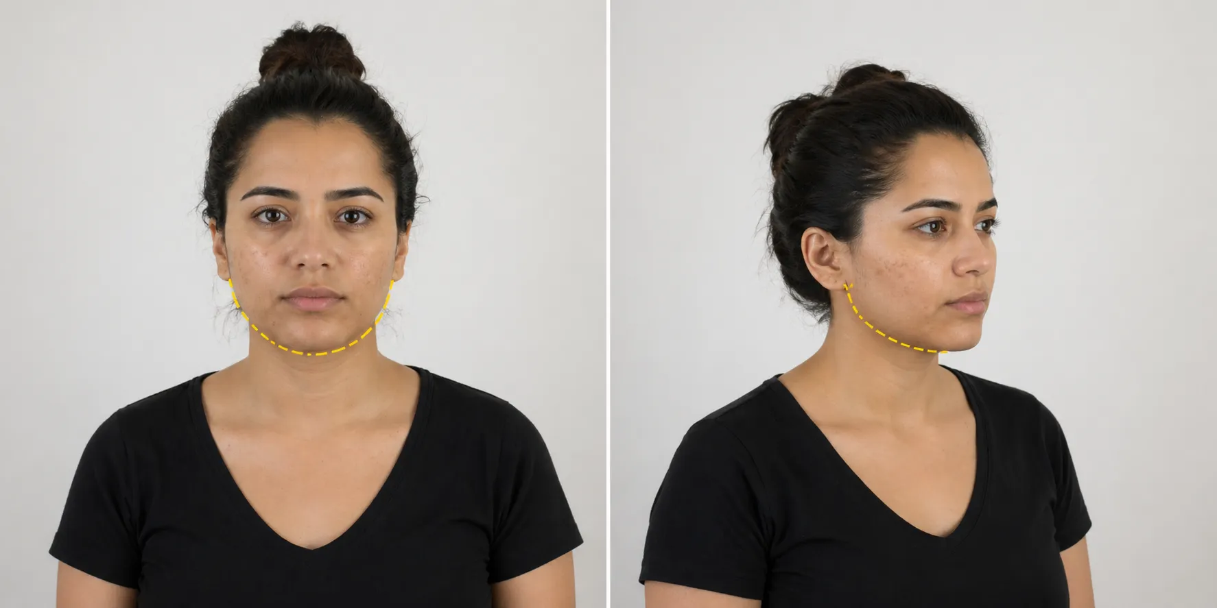 scar-removal-Jawline