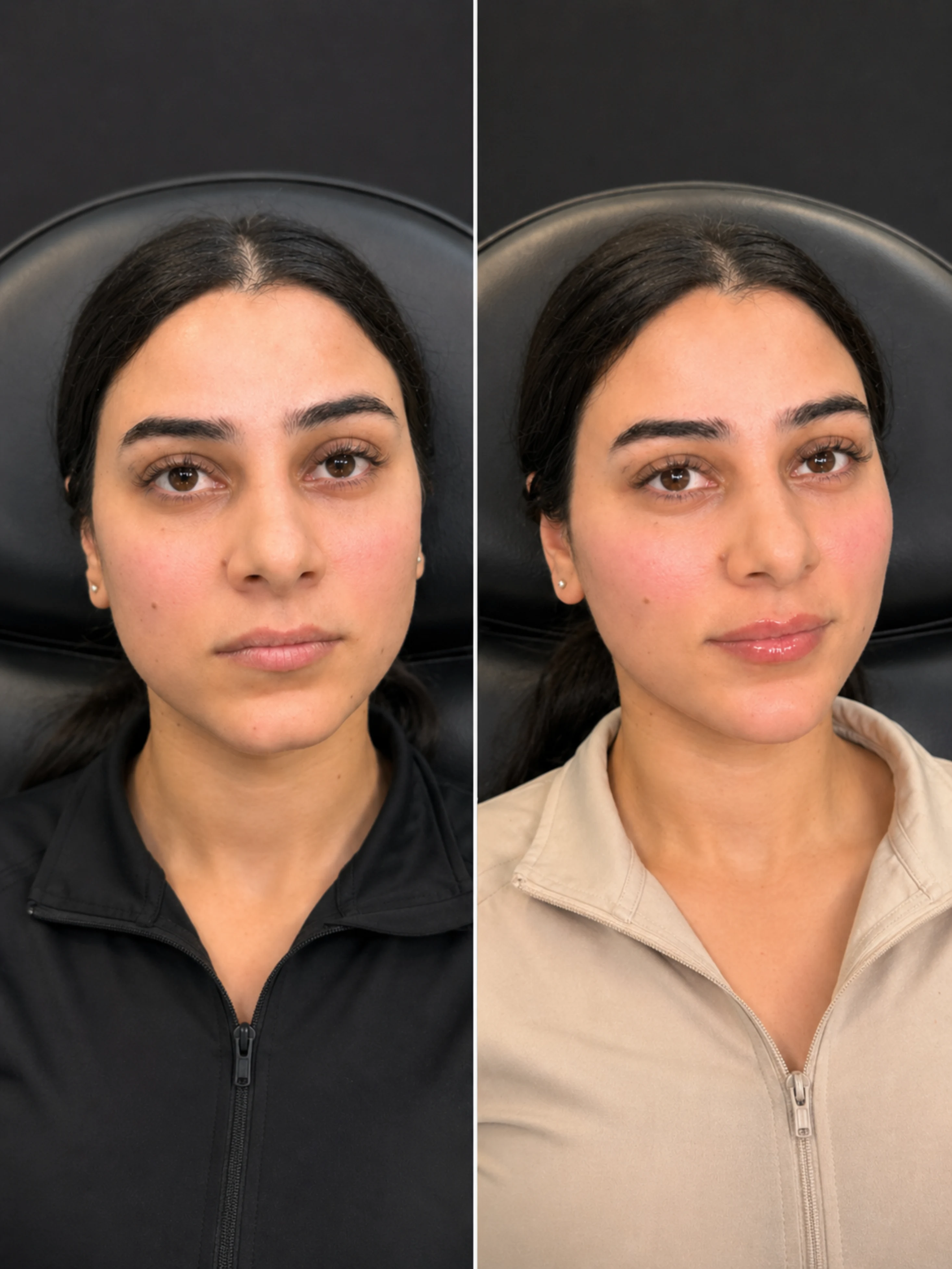 chin-filler-Dubai-results