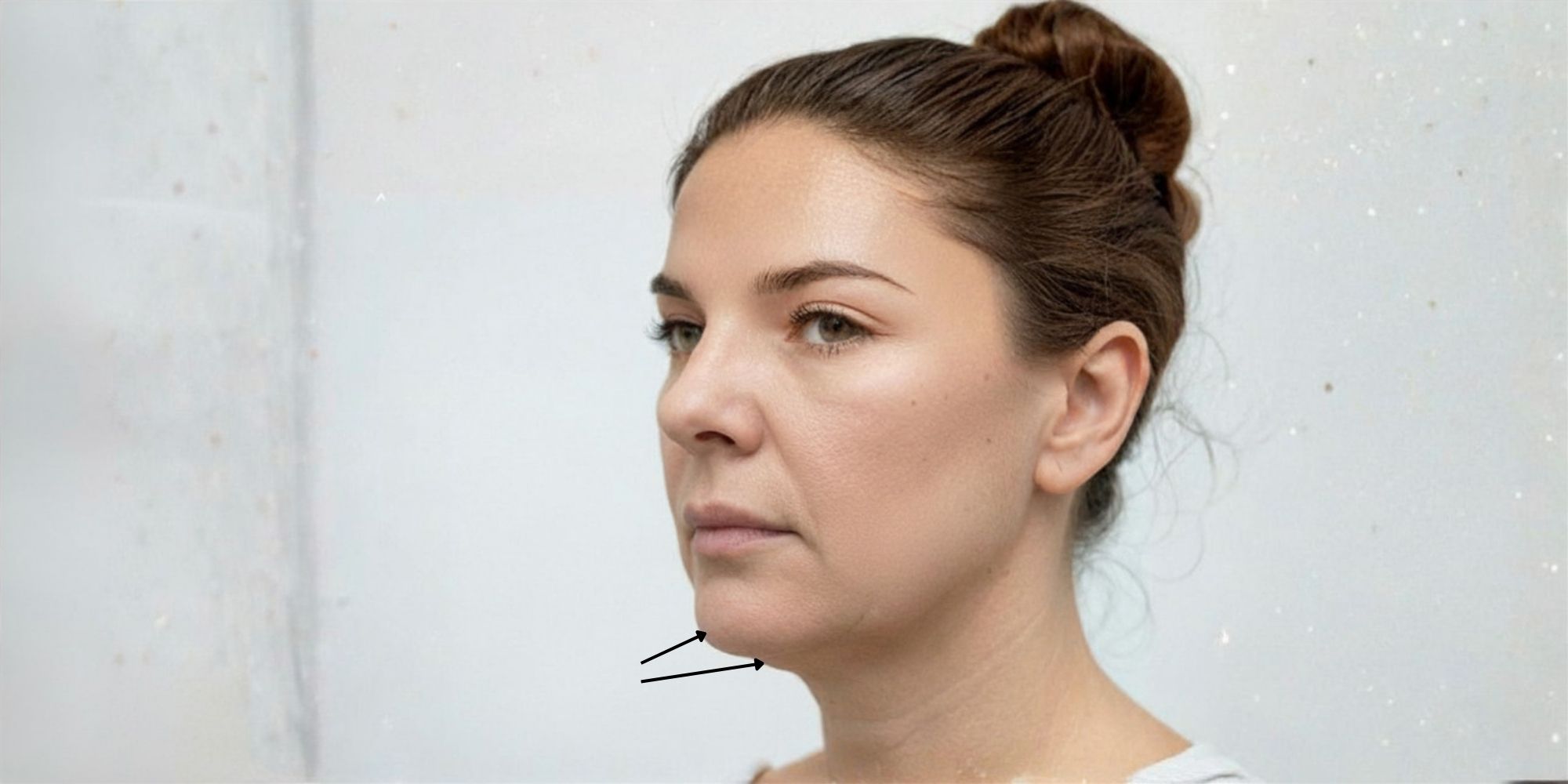 chin-filler-Pre-Jowl-Area