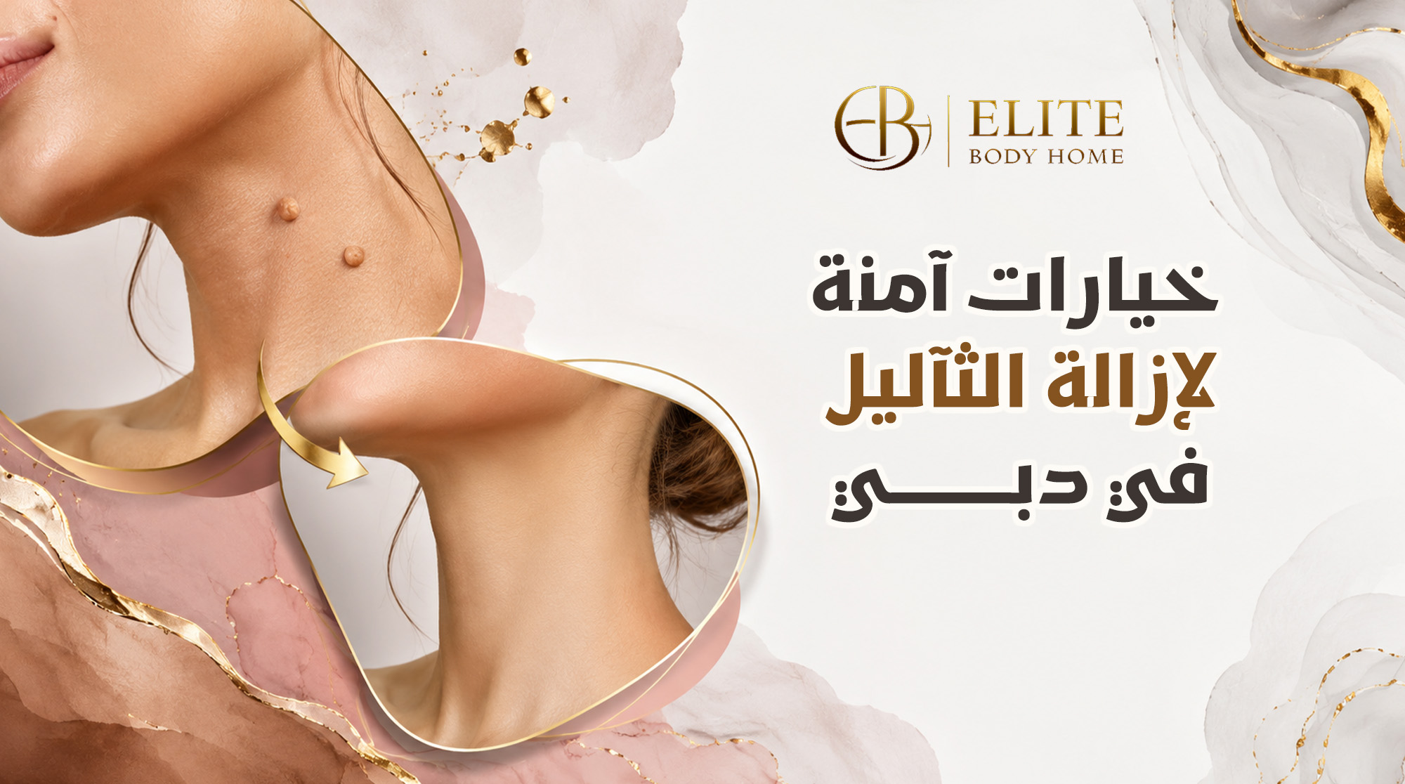 خيارات آمنة لإزالة الثآليل في دبي (Warts Removal Dubai)