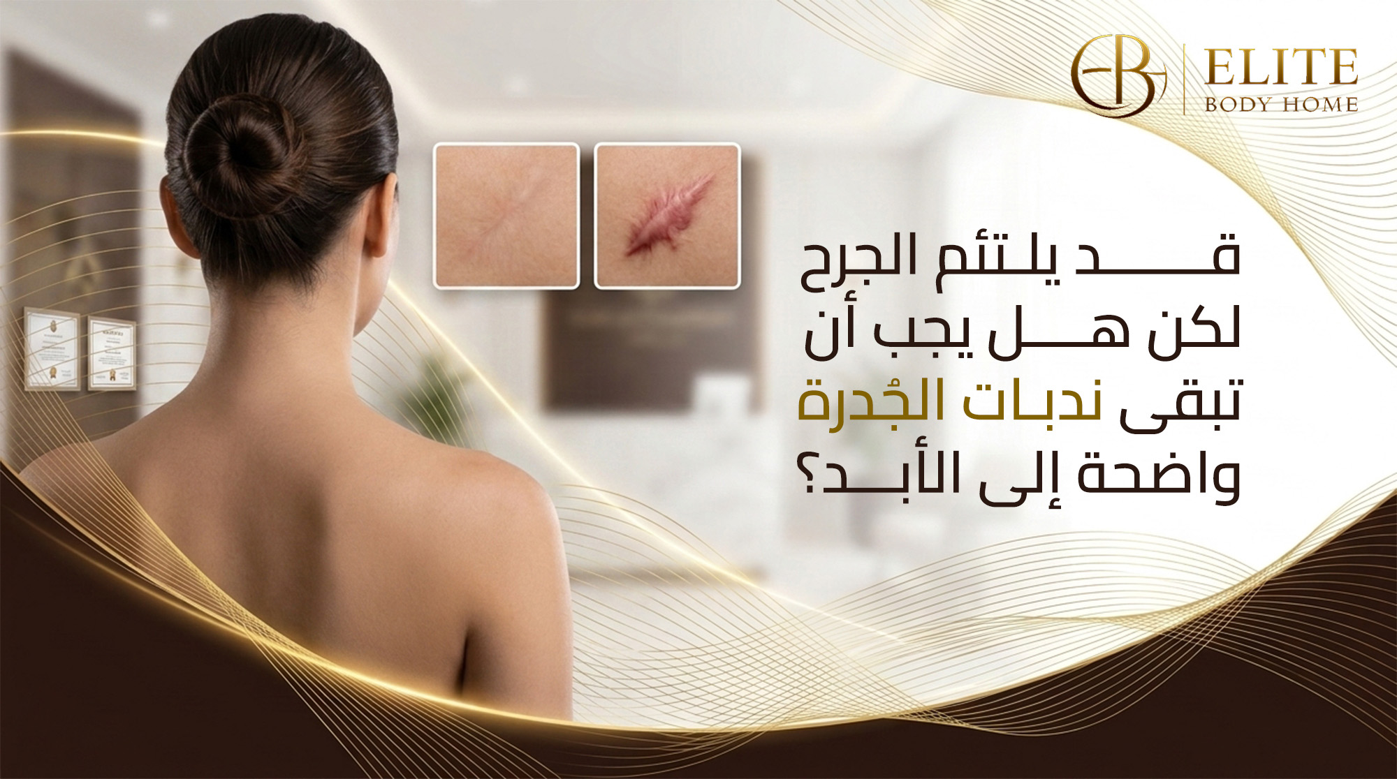 قد يلتئم الجرح... لكن هل يجب أن تبقى ندبات الجُدرة ( Keloid Scar ) واضحة إلى الأبد؟